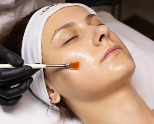 A Guide To Professional Chemical Peel Benefits
